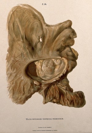 view A diseased stomach. Chromolithograph by W. Gummelt, ca. 1897.