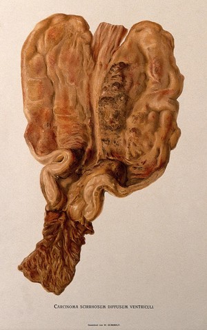 view A diseased stomach, showing signs of cancer. Chromolithograph by W. Gummelt, ca. 1897.