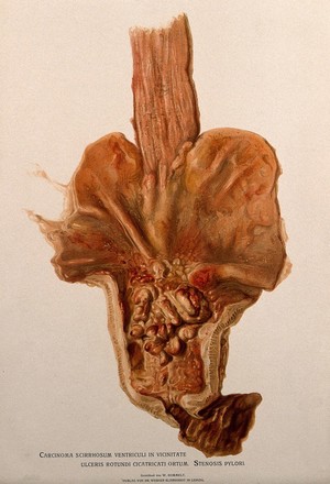 view A diseased stomach, showing signs of cancer. Chromolithograph by W. Gummelt, ca. 1897.