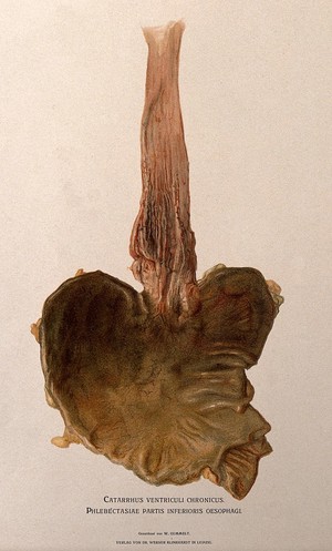 view A diseased stomach and oesophagus. Chromolithograph by W. Gummelt, ca. 1897.