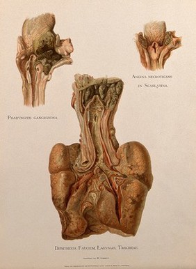Dissections of a diseased pharynx, larynx and tracheae: three figures. Chromolithograph by W. Gummelt, ca. 1897.