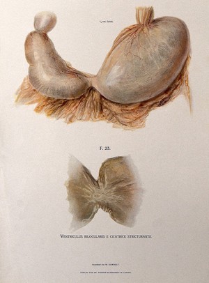 view Hourglass stomach caused by scarring around an ulcer: two figures. Chromolithograph after W. Gummelt, ca. 1897.