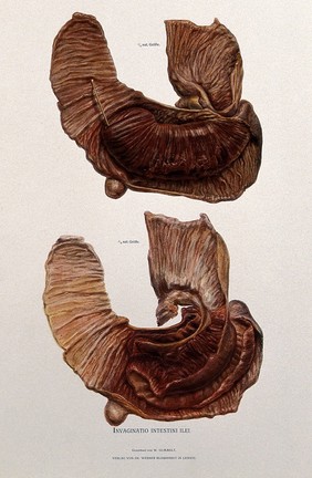 Dissections of a blocked or diseased intestine: two figures. Chromolithograph by W. Gummelt, ca. 1897.