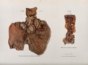 view Dissections of an ulcerated stomach caused by syphilis, and a severe case of ulcerated proctitis of the rectum (?): two figures. Chromolithograph by W. Gummelt, ca. 1897.