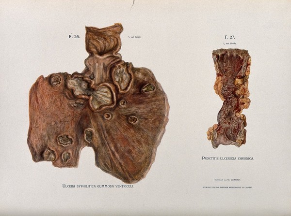 Dissections of an ulcerated stomach caused by syphilis, and a severe case of ulcerated proctitis of the rectum (?): two figures. Chromolithograph by W. Gummelt, ca. 1897.