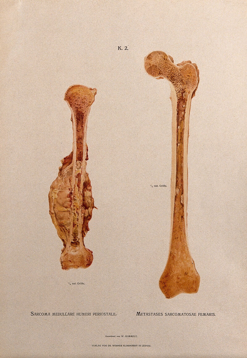 Sections through humerus and femur bones, two figures: the left ...