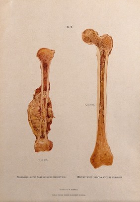 Sections through humerus and femur bones, two figures: the left illustration indicating a sarcoma (bone tumour) on the humerus bone, the right showing cancerous (?) metastases in the marrow of the femur. Chromolithograph by W. Gummelt, ca. 1897.