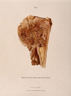 Section through part of a tibia bone, showing diseased tissue and a cancerous (?) sarcoma (bone tumour). Chromolithograph by W. Gummelt, ca. 1897.