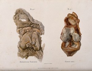 view Sections of two knee joints: left, bone affected by arthropathy, right, an inflamed knee joint. Chromolithograph by W. Gummelt, ca. 1897.