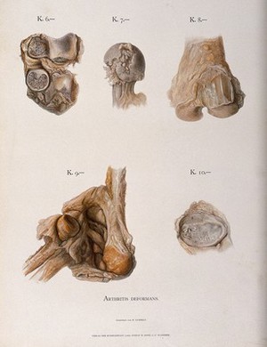 view Bones and joints deformed by arthritis: five figures. Chromolithograph by W. Gummelt, ca. 1897.