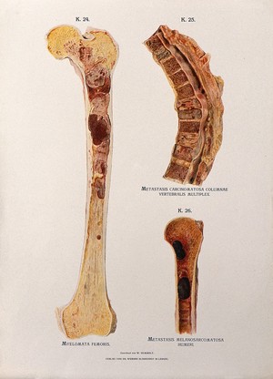 view Sections through diseased femor, spinal and humerus bones: three figures. Chromolithograph by W. Gummelt, ca. 1897.