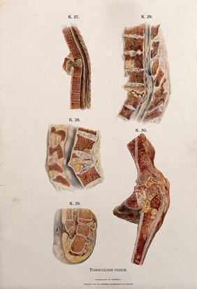 Sections through diseased bones affected by tuberculosis. Chromolithograph by W. Gummelt, ca. 1897.