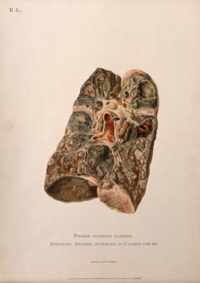 A diseased lung, with an aneurysm of the pulmonary artery. Chromolithograph by W. Gummelt, ca. 1897.