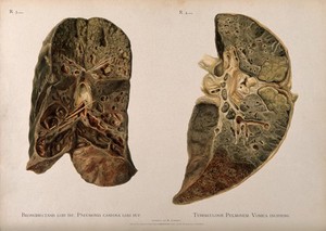 view Dissections of diseased lungs affected by pneumonia and tuberculosis: two figures. Chromolithograph by W. Gummelt, ca. 1897.