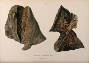 view Dissections of diseased lungs affected by gangrene: two figures. Chromolithograph by W. Gummelt, ca. 1897.