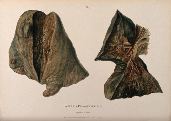 Dissections of diseased lungs affected by gangrene: two figures. Chromolithograph by W. Gummelt, ca. 1897.