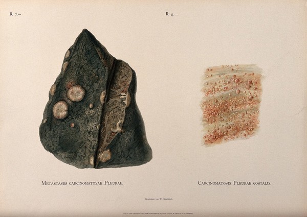 A diseased lung affected cancer on the pleura, shown with a detail of the pleura: two figures. Chromolithograph by W. Gummelt, ca. 1897.