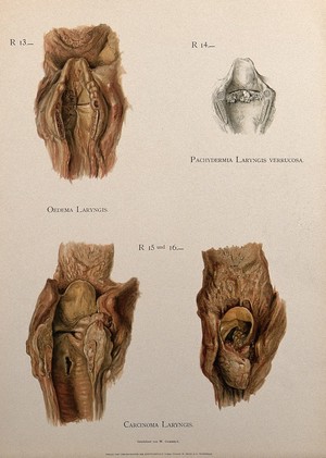 view Dissections of larynxes affected by diseases including cancer: four figures. Chromolithograph by W. Gummelt, ca. 1897.