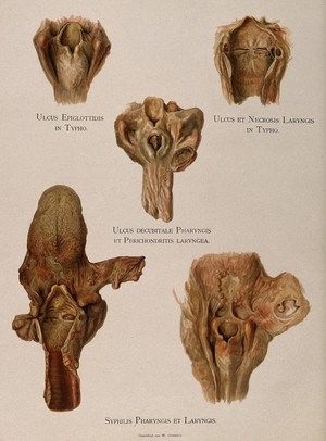 view Dissections of pharynxes and larynxes affected by diseases including syphilis. Chromolithograph by W. Gummelt, ca. 1897.