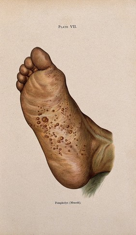 A rash of eczema on the sole of a foot, showing symptoms of pompholyx. Colour lithograph after Mracek (?), ca. 1905.