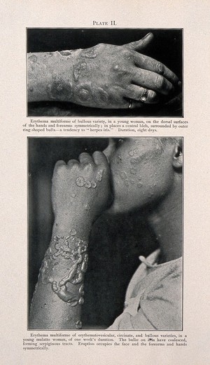 view The hand of a young woman suffering from erythema multiforme, with the arm, hand and face of a young woman of mixed-race, shown below, also displaying symptoms of the disease. Process print after a photograph, ca. 1905.