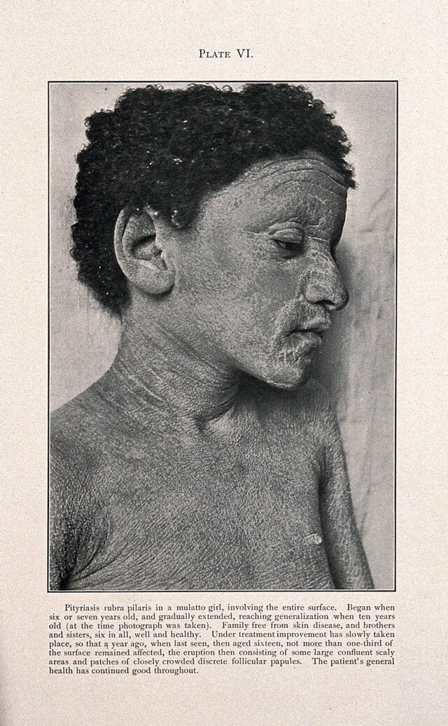 Face and chest of a young girl of mixed-race, showing skin affected by ...