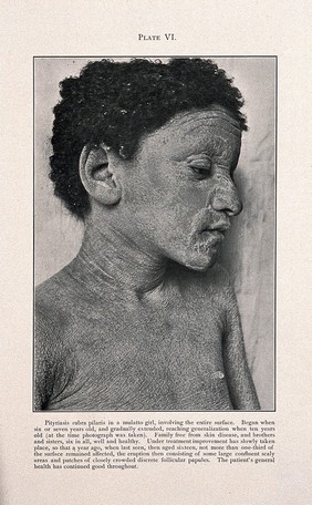 Face and chest of a girl of mixed-race, showing skin affected by pityriasis rubra pilaris. Process print after a photograph, ca. 1905.