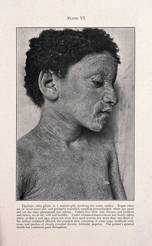 view Face and chest of a girl of mixed-race, showing skin affected by pityriasis rubra pilaris. Process print after a photograph, ca. 1905.