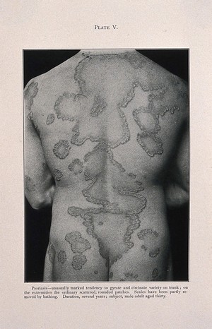 view Areas of psoriasis on the back of a thirty year old man. Process print after a photograph, ca. 1905.