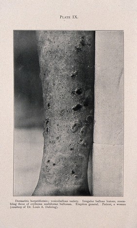 The arm of a woman suffering from dermatitis herpetiformis. Process print after a photograph, ca. 1905.