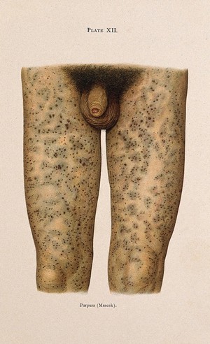 view The thighs and genitals of a man suffering from purpura. Colour lithograph after Mracek (?), ca. 1905.