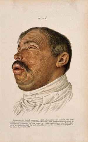 view The face of a man suffering from acute eczema and dermatitis, caused by irritant drug applications and poison ivy. Colour lithograph after Mracek (?), ca. 1905.