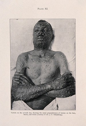 view A man of African descent with variola lesions on his face, torso, arms and hands. Process print after a photograph, ca. 1905.