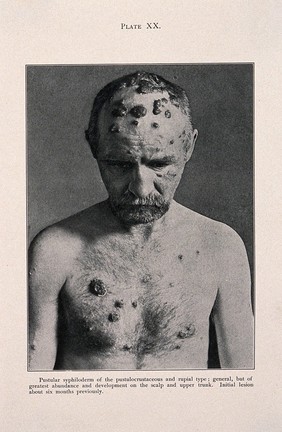 A man suffering from syphilis, displaying pustular syphiloderm lesions on his scalp and torso. Process print after a photograph, ca. 1905.