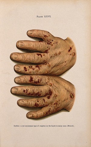 view Eruptions on the hands of a patient suffering from scabies. Colour lithograph after Mracek (?), ca. 1905.