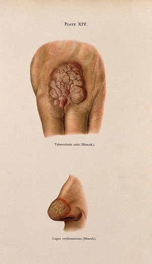 view Above, eruption of tuberculosis cutis between the fingers, below, skin on the tip of the nose affected by lupus erythematosus. Colour lithograph after Mracek (?), ca. 1905.