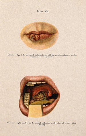 view Above, diseased skin on a mouth, showing symptoms of chancre of the lip, below, an open mouth with diseased tissue showing symptoms of chancre of the right tonsil. Colour lithograph after Mracek (?), ca. 1905.