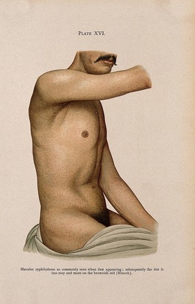 The torso and arm of a man suffering from syphilis, showing a rash of macular syphiloderm. Colour lithograph after Mracek (?), ca. 1905.