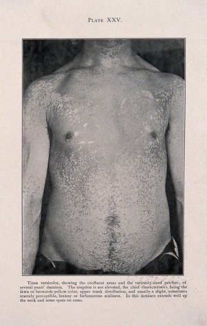 view The torso of a man, showing diseased areas of skin affected by tinea versicolor. Process print after a photograph, ca. 1905.