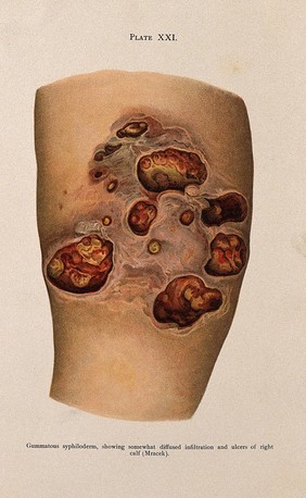 Areas of disease on the leg of a patient suffering from syphilis, showing gummatous syphiloderm and ulcers on the right calf. Colour lithograph after Mracek (?), ca. 1905.