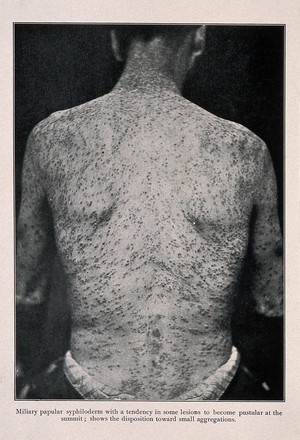 view The back of a man suffering from syphilis, showing a rash caused by miliary papular syphiloderm. Process print after a photograph, ca. 1905.