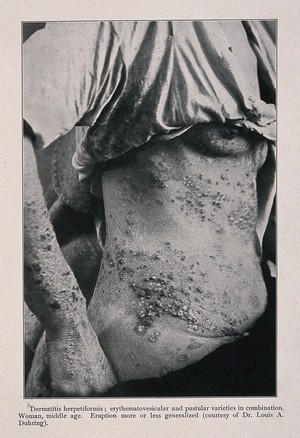 view The torso and arm of a woman suffering from dermatitis herpetiformis. Process print after a photograph, ca. 1905.