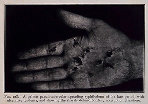 view The hand of a patient suffering from syphilis, showing a palmar papulotubercular spreading syphiloderm. Process print after a photograph, ca. 1905.