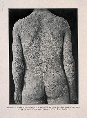 view The back, buttocks and arms of a man suffering from psoriasis. Process print after a photograph, ca. 1905.