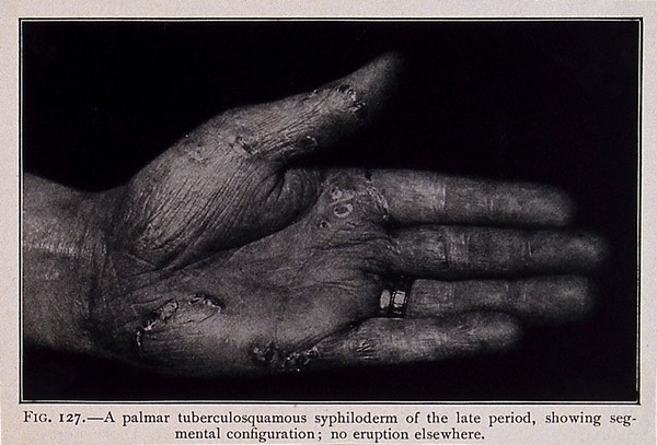 The hand of a patient suffering from syphilis, showing a palmar tuberculosquamus syphiloderm. Process print after a photograph, ca. 1905.