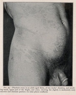 view The abdomen, upper thigh and genitals of a thirty year old man suffering from pityriasis rosea. Process print after a photograph, ca. 1905.
