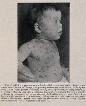 The face and torso of a baby girl suffering from urticaria pigmentosa. Process print after a photograph, ca. 1905.