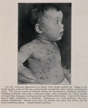 view The face and torso of a baby girl suffering from urticaria pigmentosa. Process print after a photograph, ca. 1905.