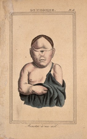 A deformed child with one eye in the centre of its face. Etching with watercolour, 1818.