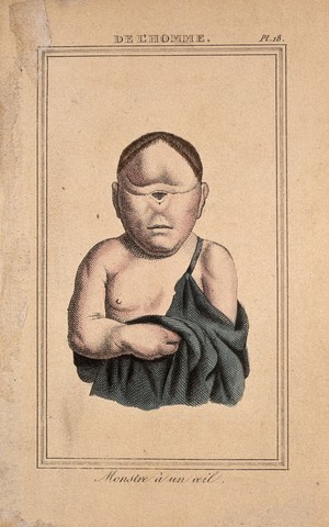 view A deformed child with one eye in the centre of its face. Etching with watercolour, 1818.